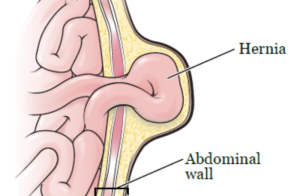 Abdominal Wall Hernia