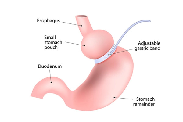 Gastric band removal