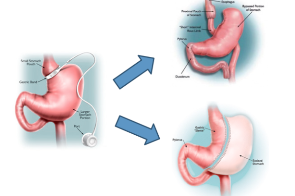 Revision bariatric surgery
