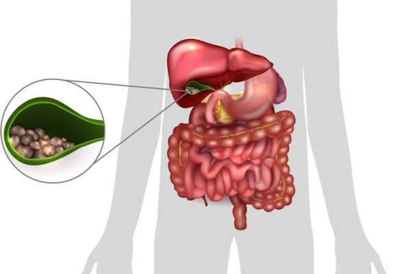 Cholecystectomy