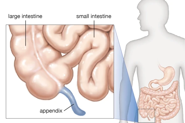 Appendectomy